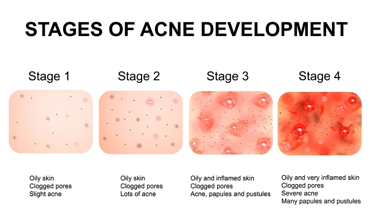 What causes monsoon acne and how to deal with it?